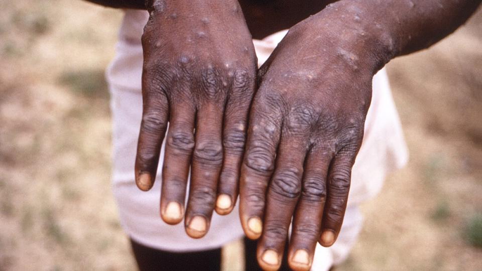 Monkey pox: how long can the disease last?